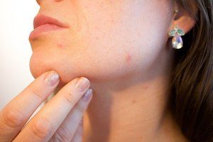 acne-1606765_640 face scars